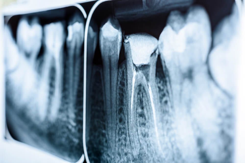 dental x ray showing root canal